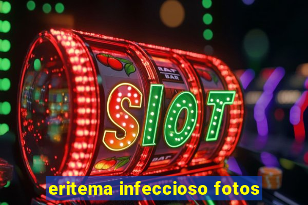 eritema infeccioso fotos